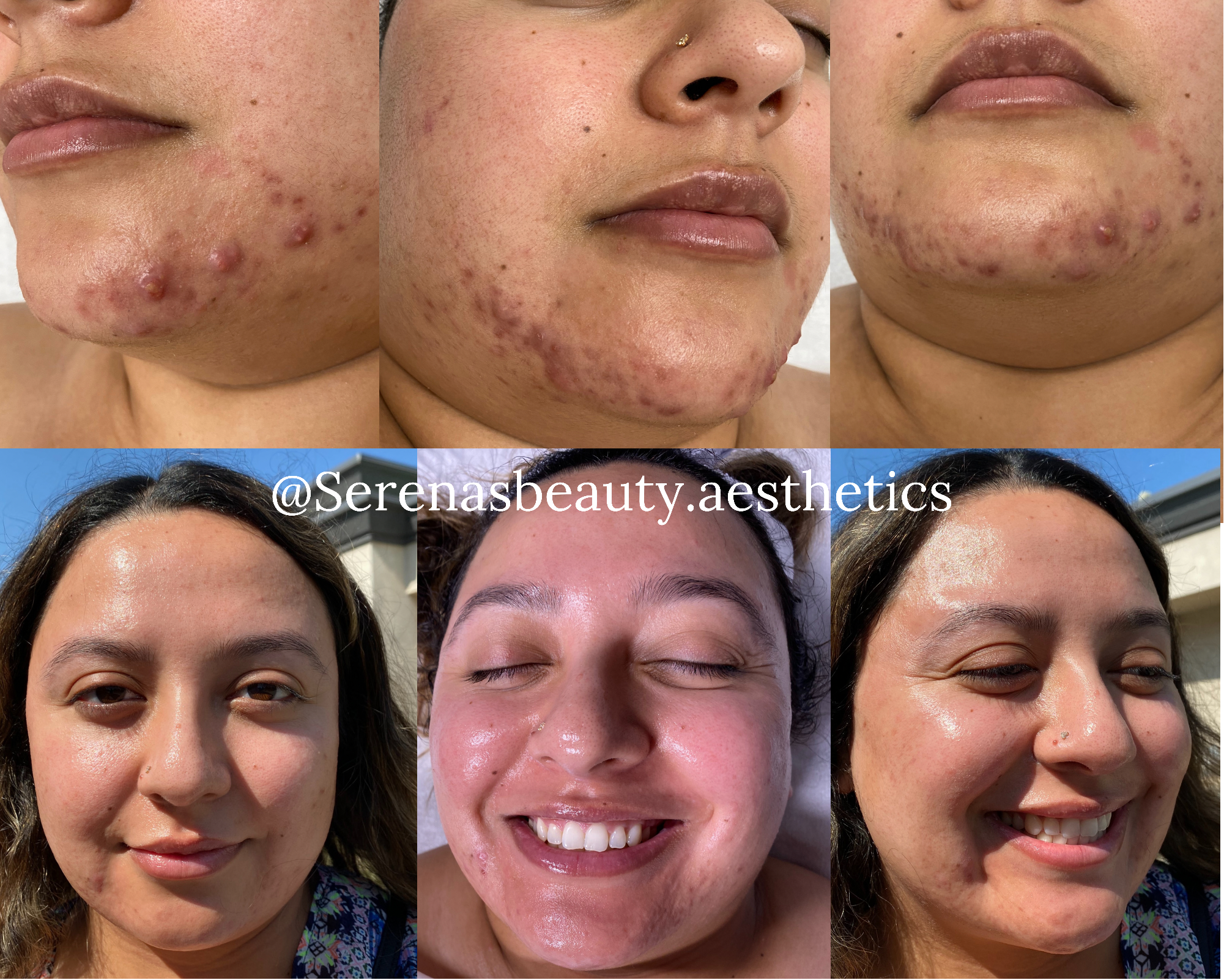 Managing Active Acne 