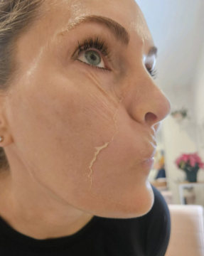 7 Days Post Lactic Peel