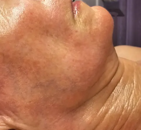Hydration Infusion on Mature Skin