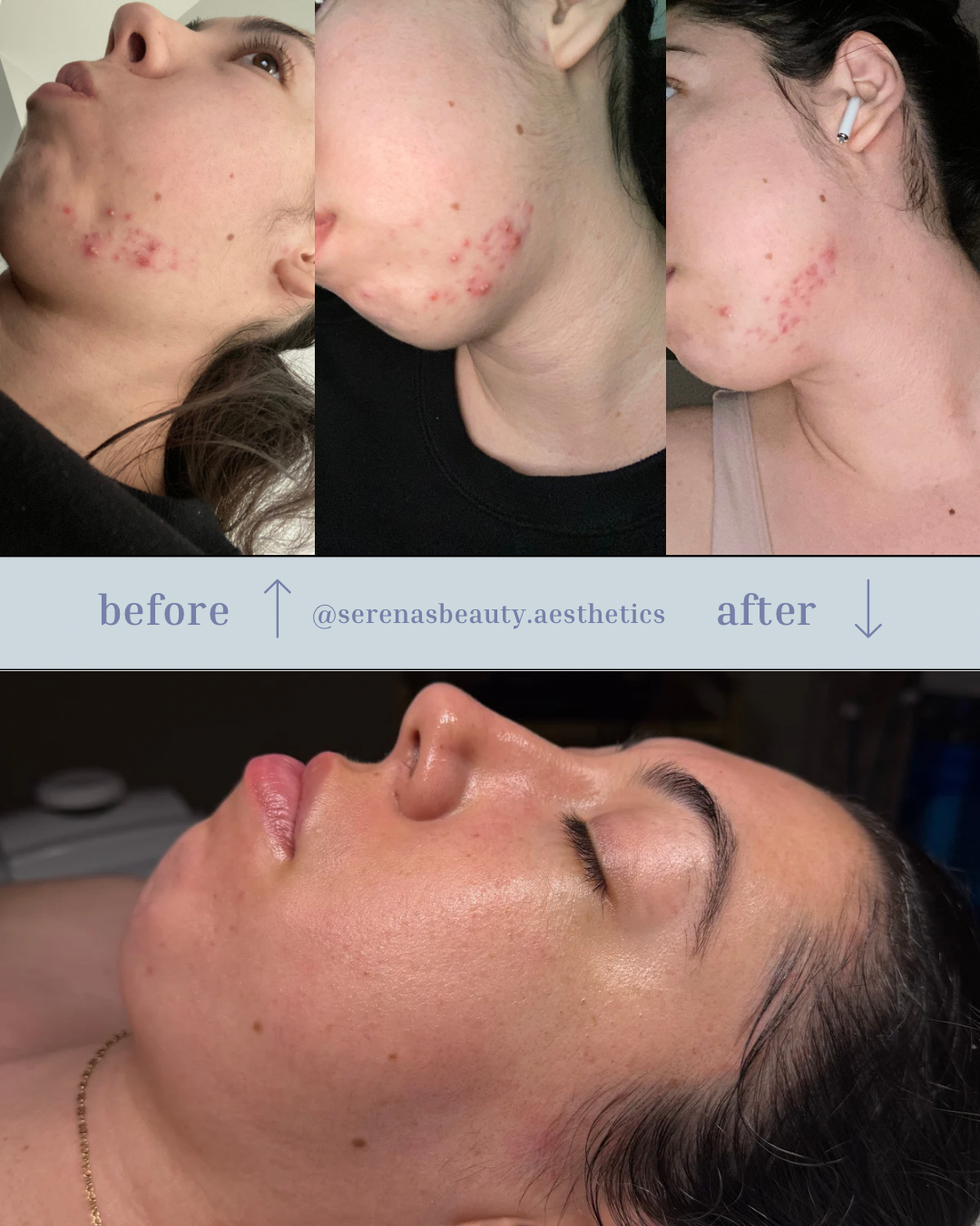 Consistent Home Routine & Blended Peels Series