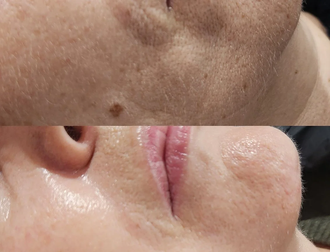 Carbon Laser Peel (5).jpg