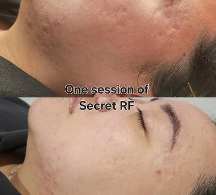 RF Skin Tightening (7).jpg