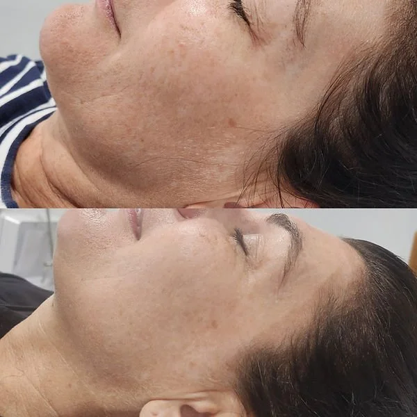 Carbon Laser Peel (4).jpg