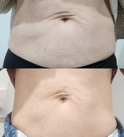 RF Skin Tightening (1).jpg