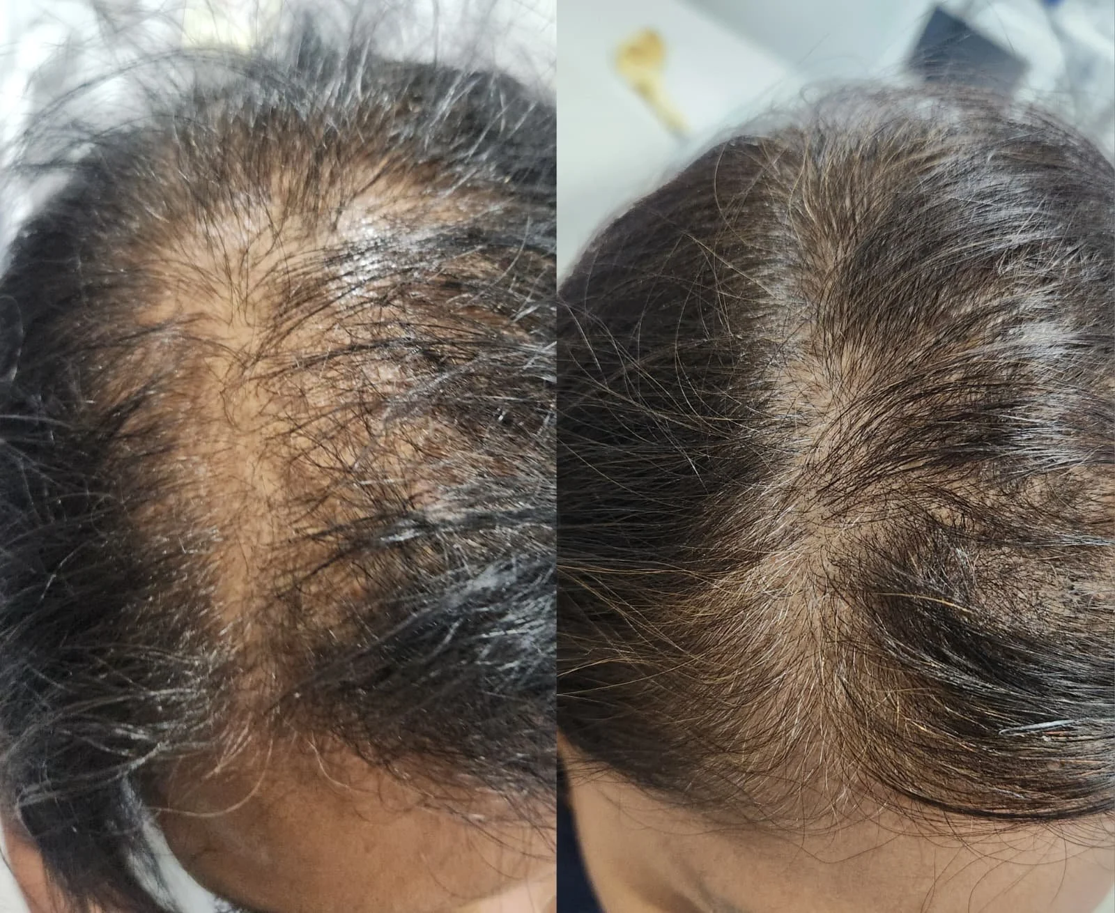 Procell Hair Restoration System (5).jpeg