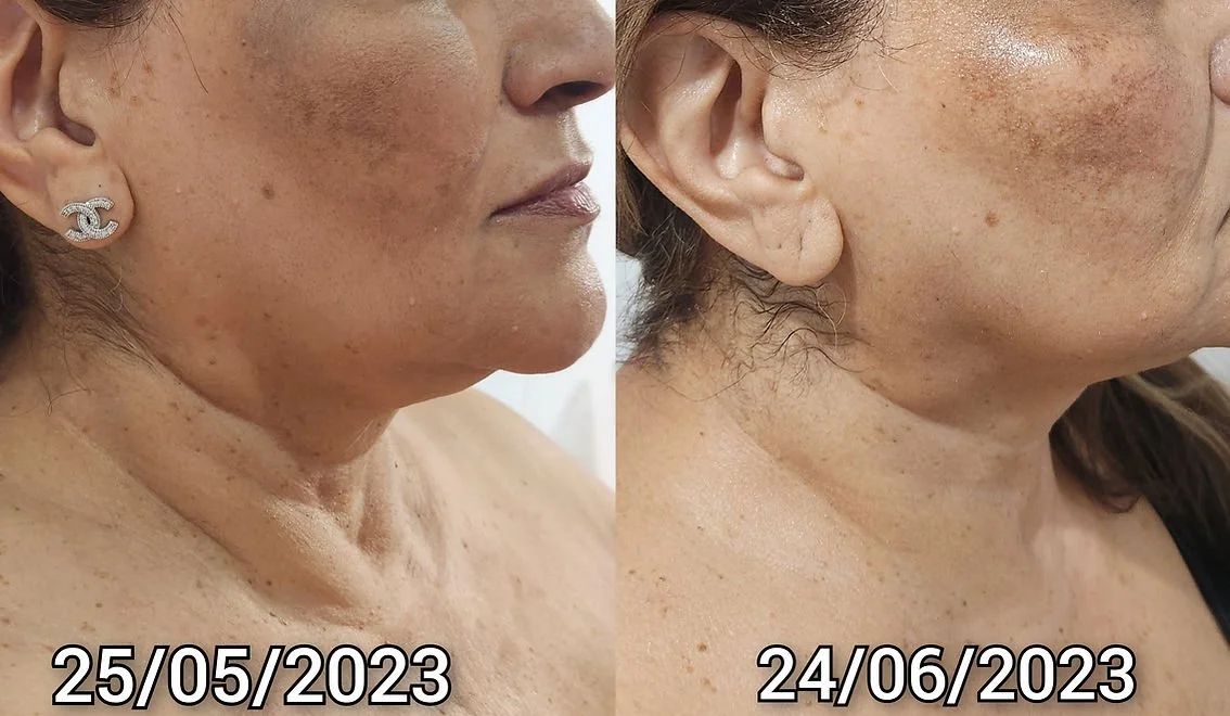 RF Skin Tightening (1).jpg