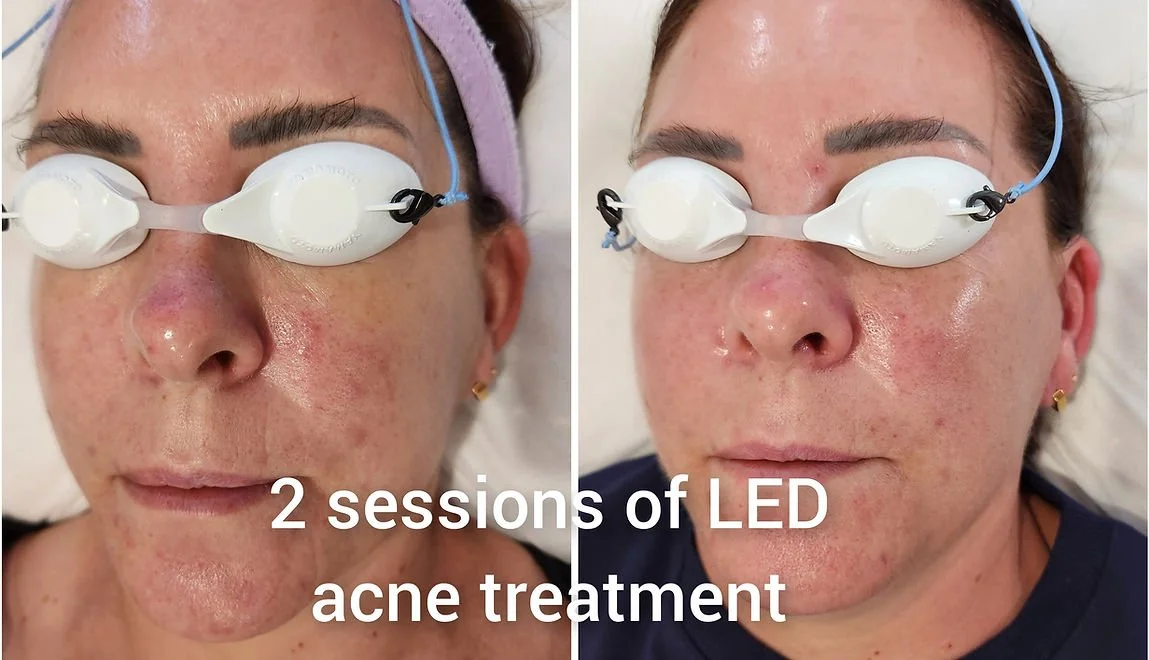 LED Light Therapy (3).jpg
