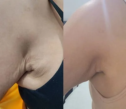 RF Skin Tightening (4).jpg