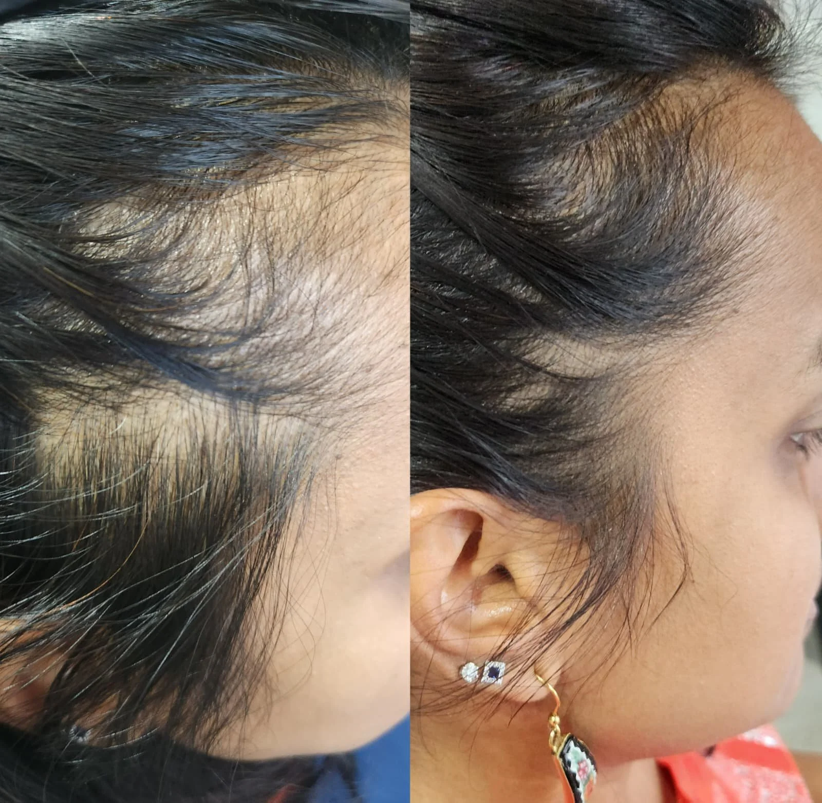 Procell Hair Restoration System (6).jpeg