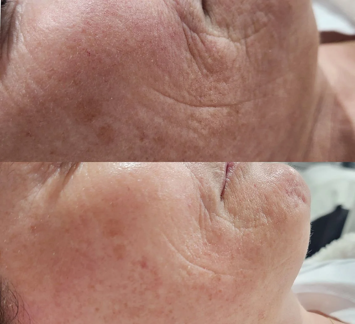Skin Peels (4).jpg