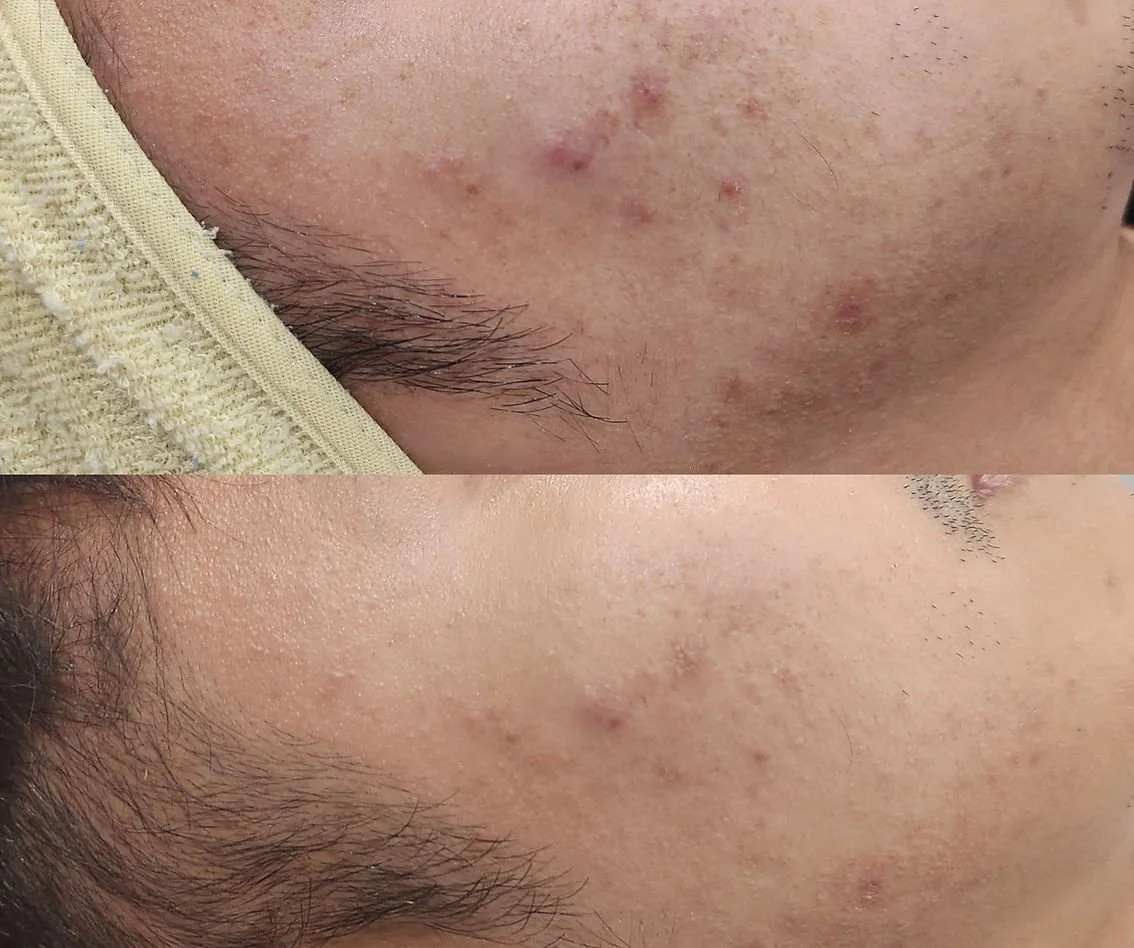 Carbon Laser Peel (1).jpg