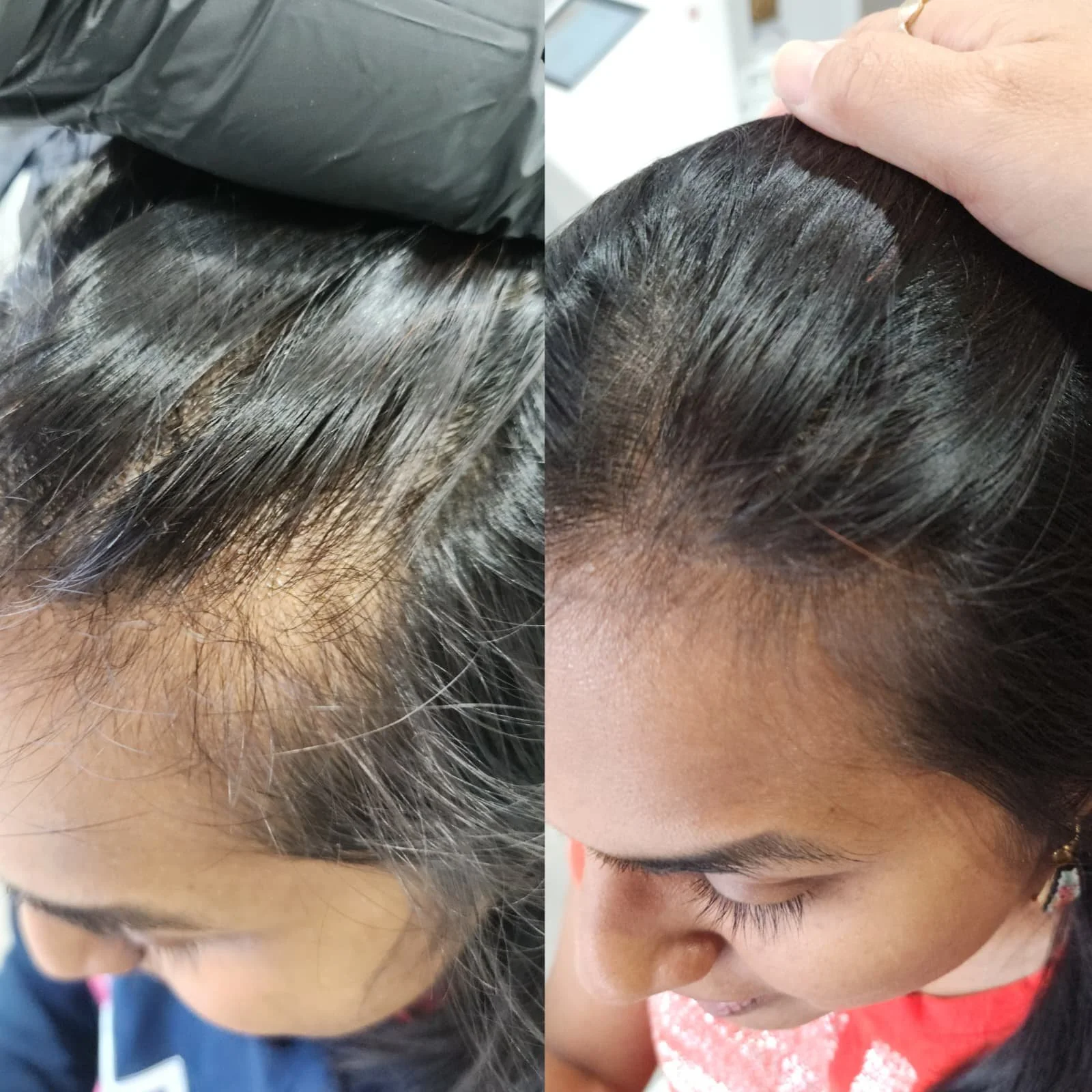 Procell Hair Restoration System (8).jpeg