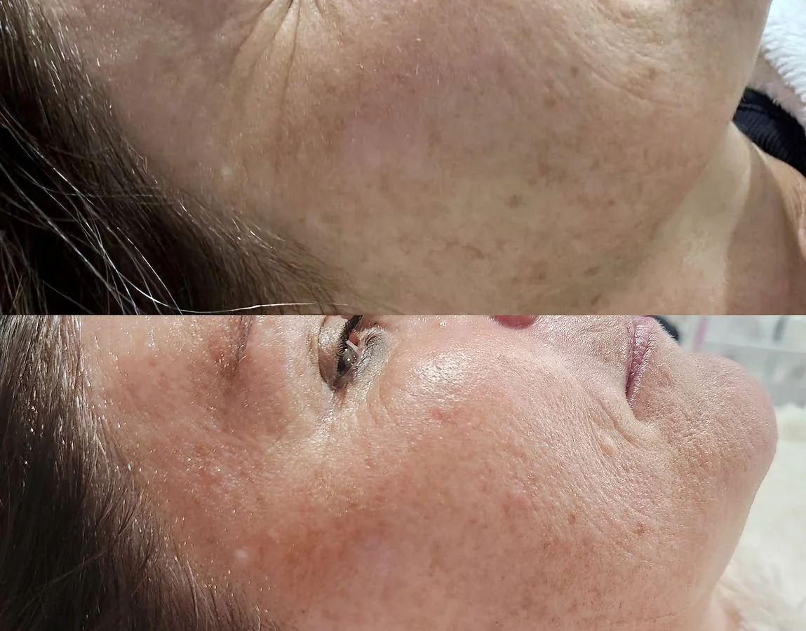 Skin Peels (1).jpg