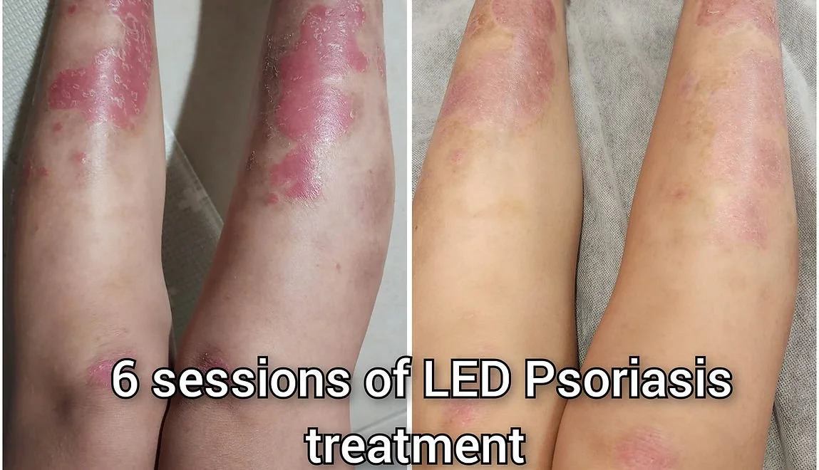 LED Light Therapy (2).jpg