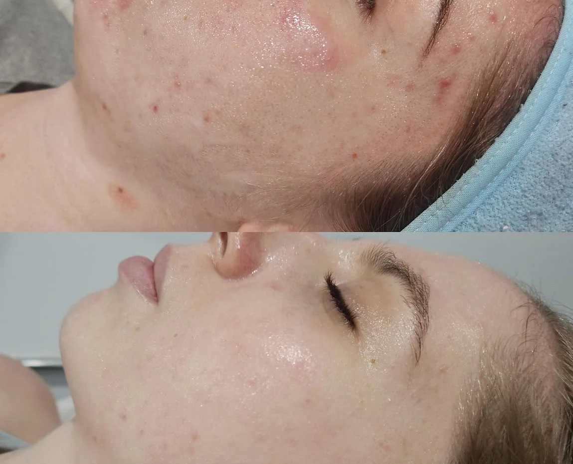 Skin Peels (3).jpg