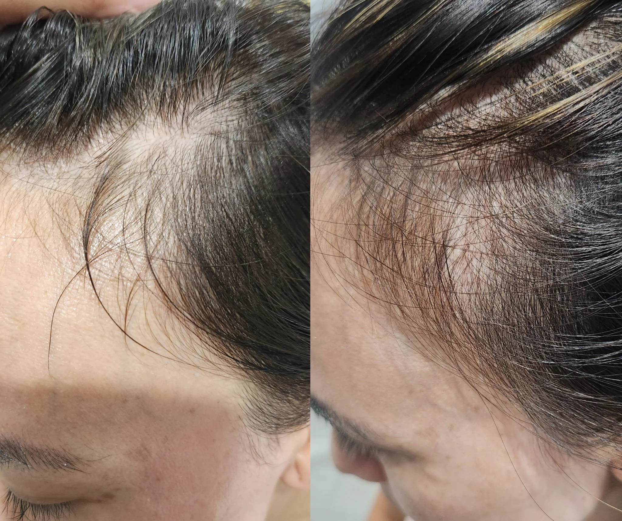 Procell Hair Restoration System (4).jpeg