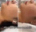 RF Skin Tightening (2).jpg