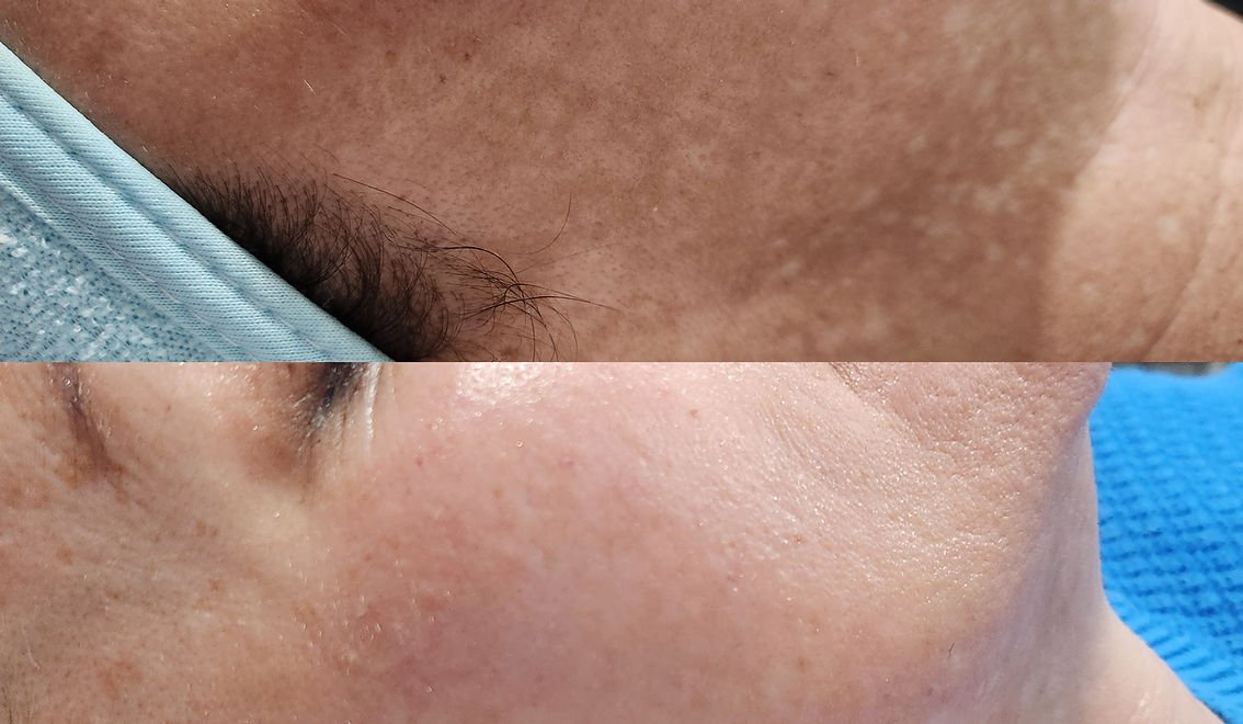 Microneedling (5).jpg
