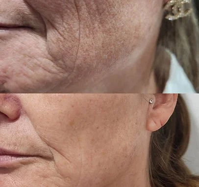 RF Skin Tightening (3).jpg