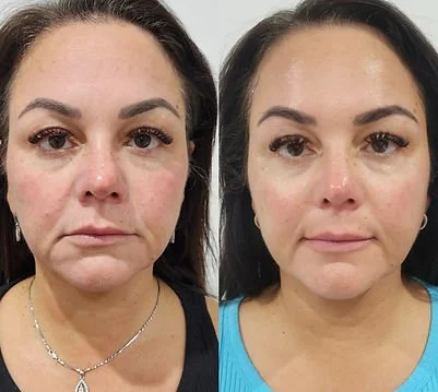 RF Skin Tightening (9).jpg