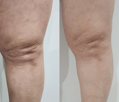 RF Skin Tightening (6).jpg