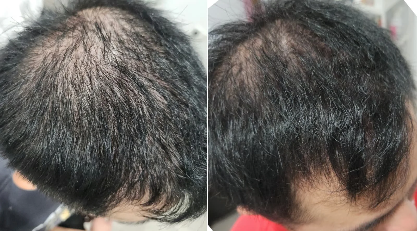 Procell Hair Restoration System (3).jpeg