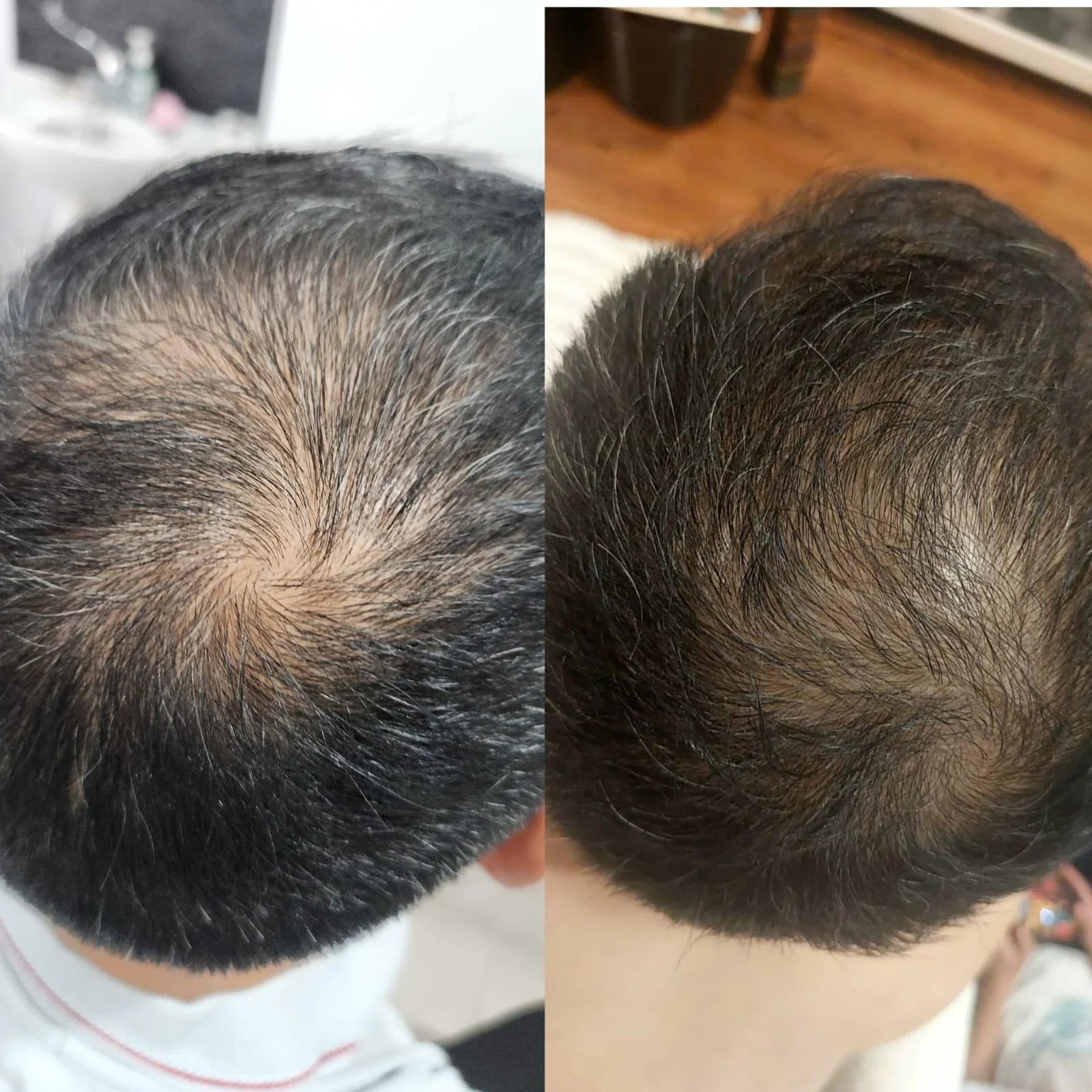 Procell Hair Restoration System (7).jpeg