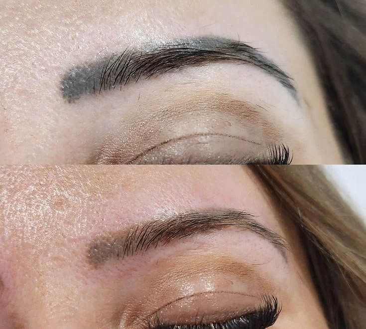 Brow Tattoo Removal (2).jpg