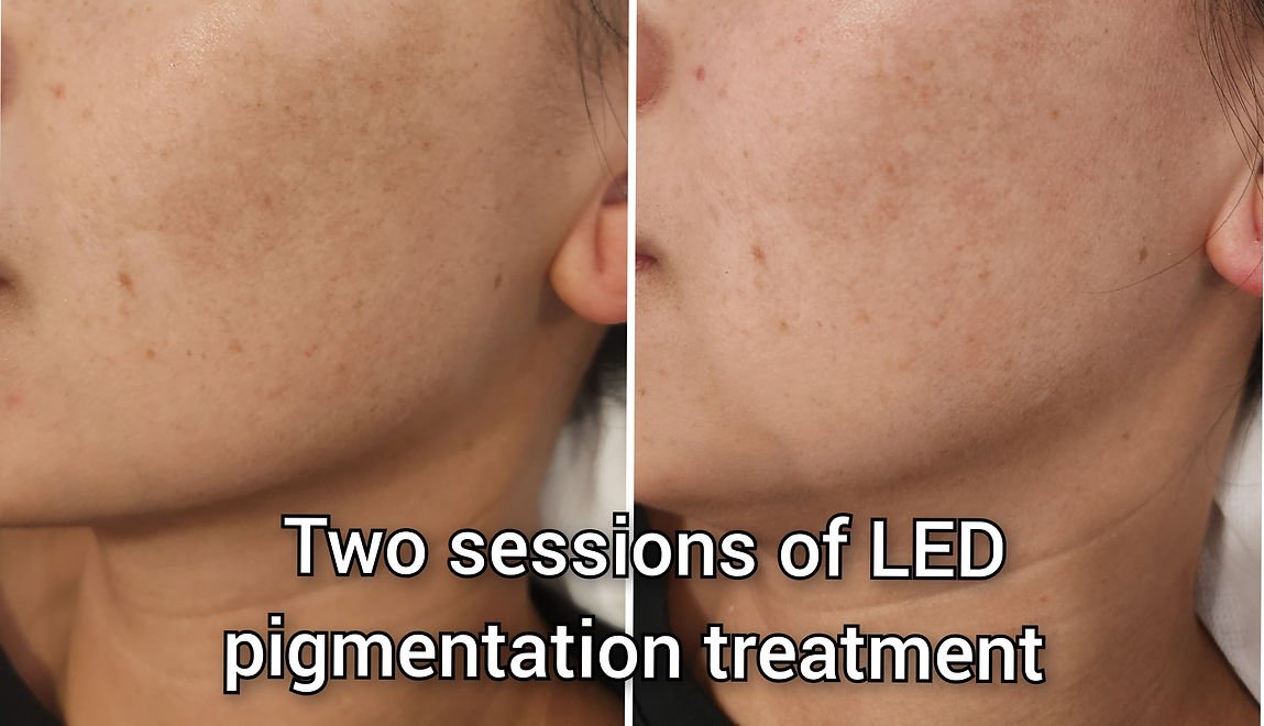 LED Light Therapy (1).jpg