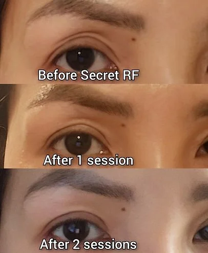 RF Skin Tightening (2).jpg