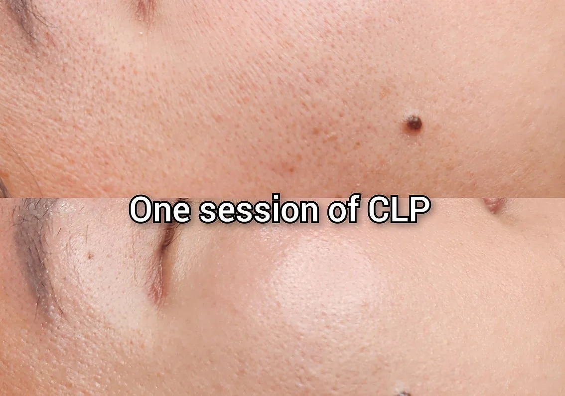 Carbon Laser Peel (3).jpg