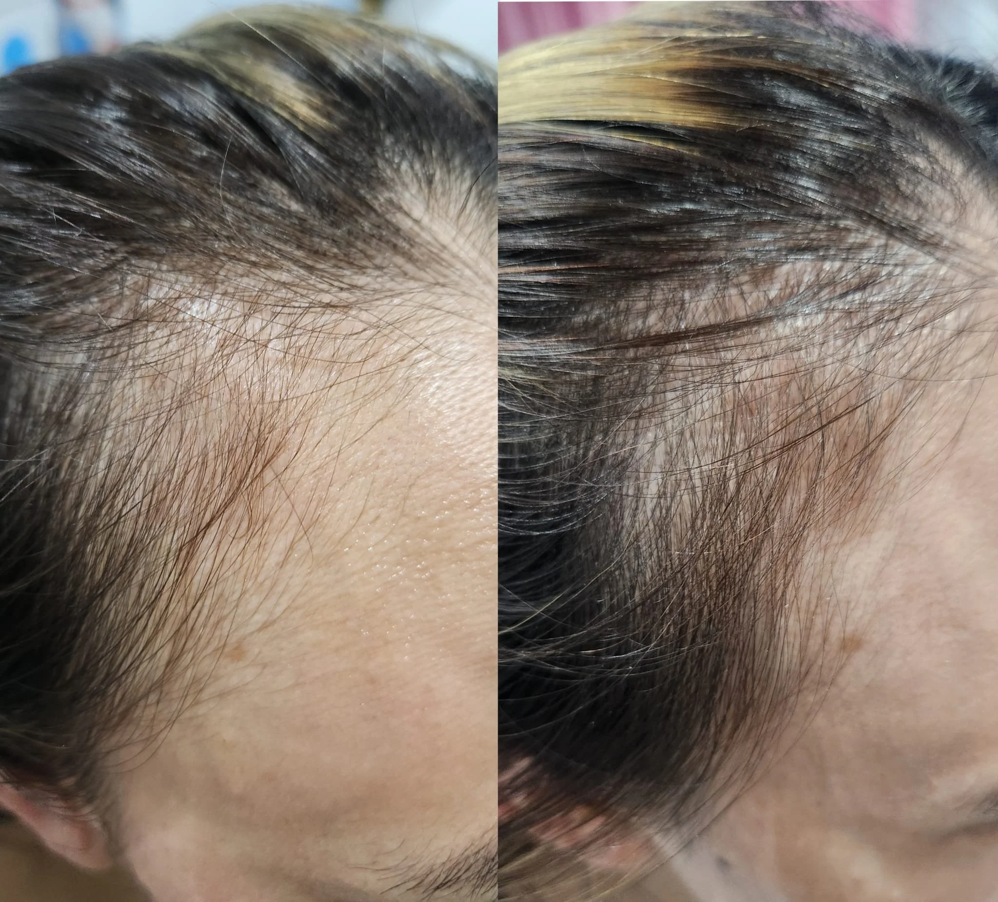 Procell Hair Restoration System (1).jpeg
