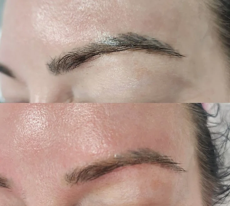 Brow Tattoo Removal (1).jpg
