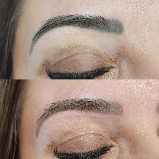 Brow Tattoo Removal (3).jpg