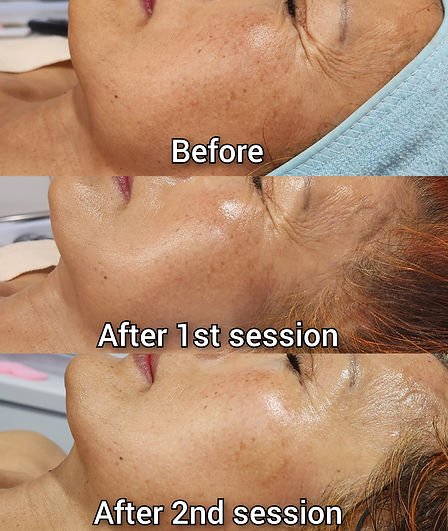 CPL Skin Rejuvenation (3).jpg