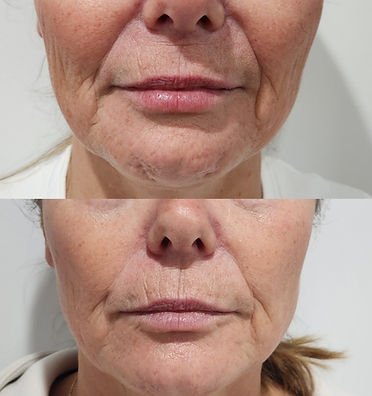 RF Skin Tightening (8).jpg