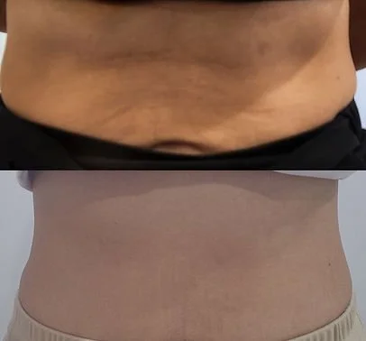 RF Skin Tightening (5).jpg
