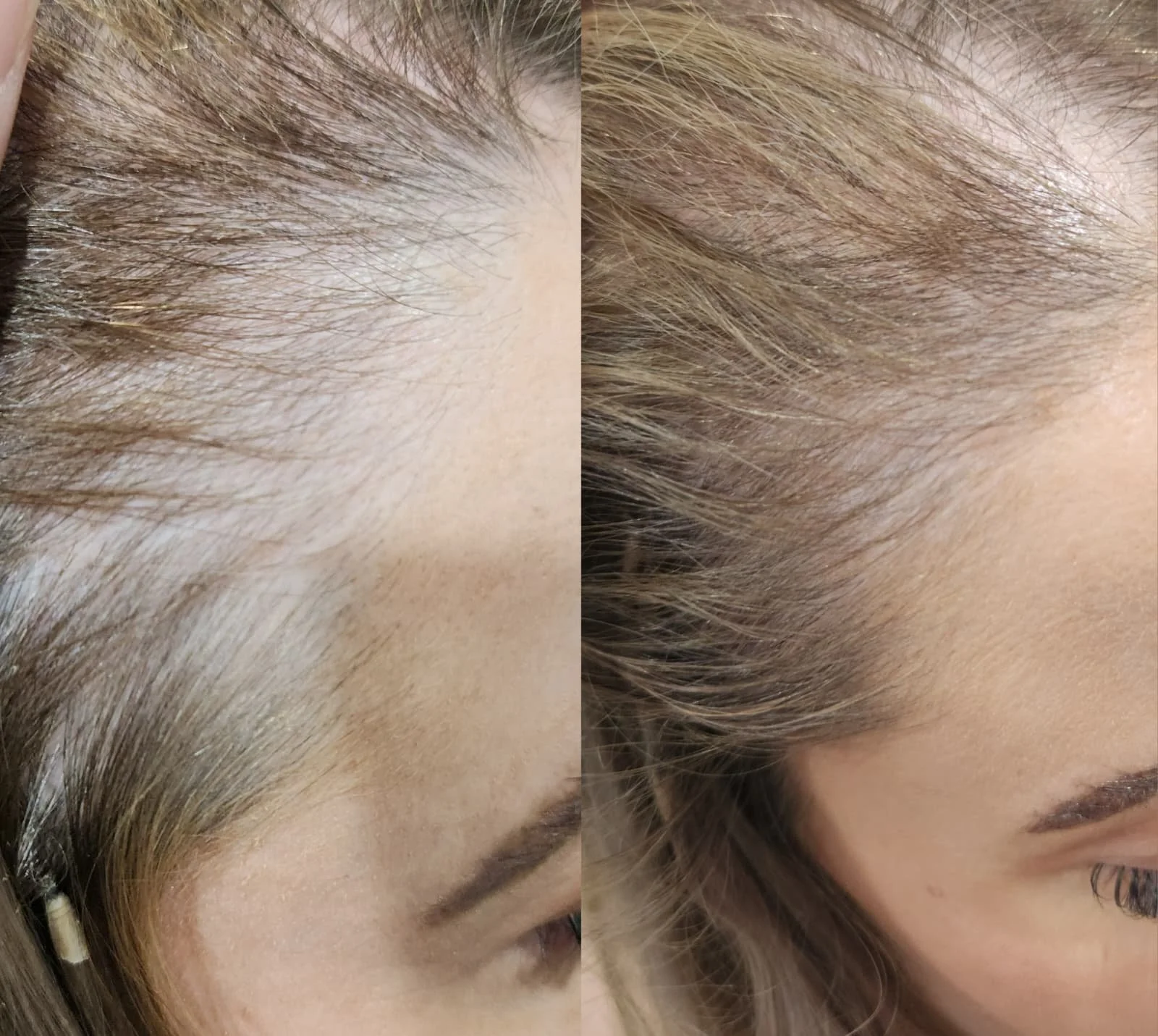 Procell Hair Restoration System (2).jpeg