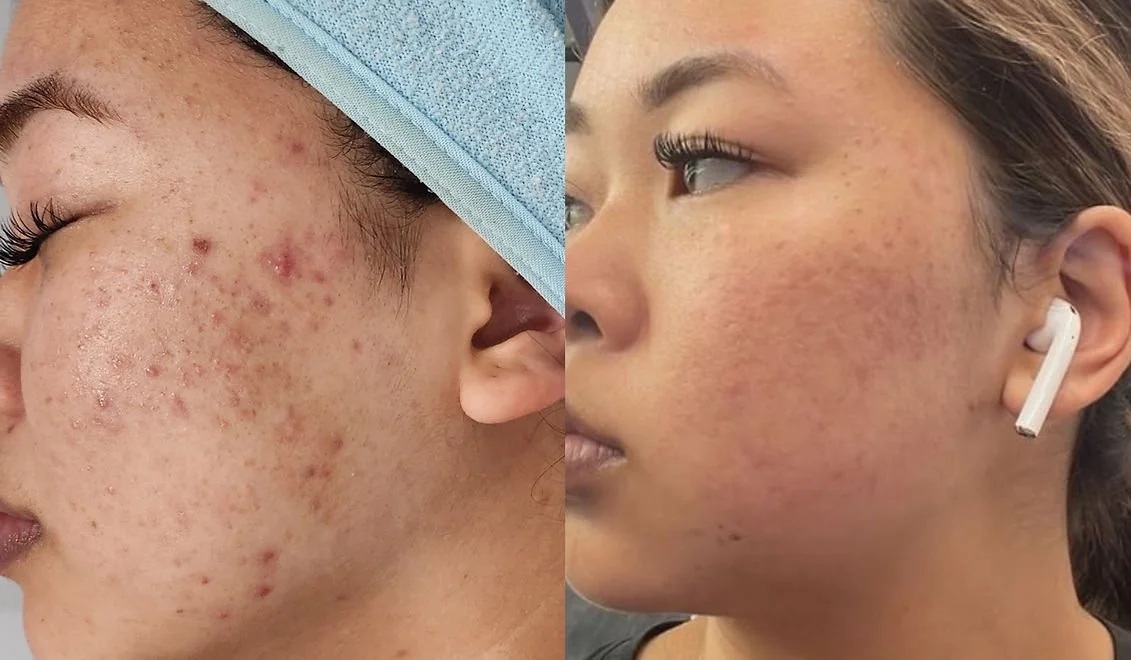 Microneedling (1).jpg