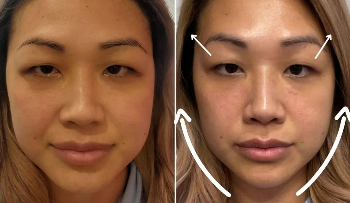 RF Skin Tightening (1).png