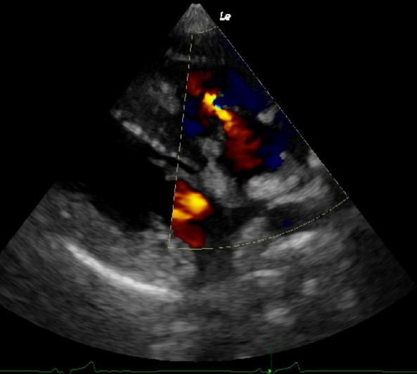 Echocardiogram with ECG