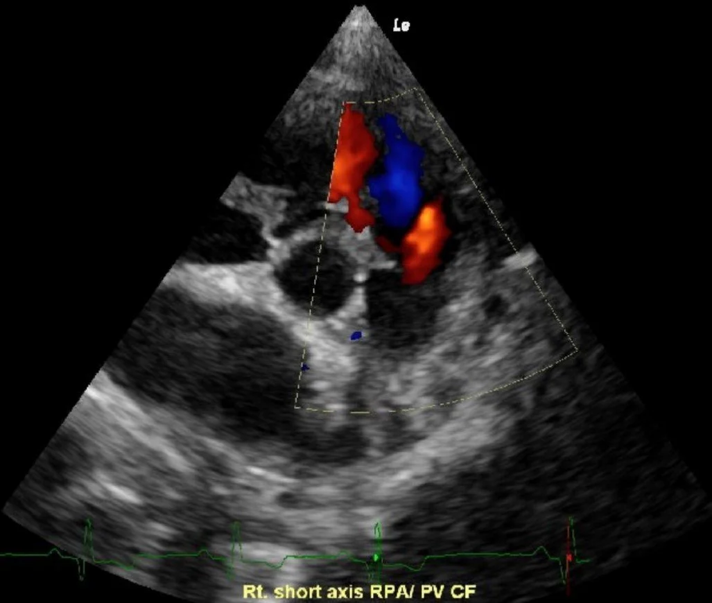 Ultrasound image of the heart showing blood flow with color Doppler, indicating flow between the right atrium and ventricle.