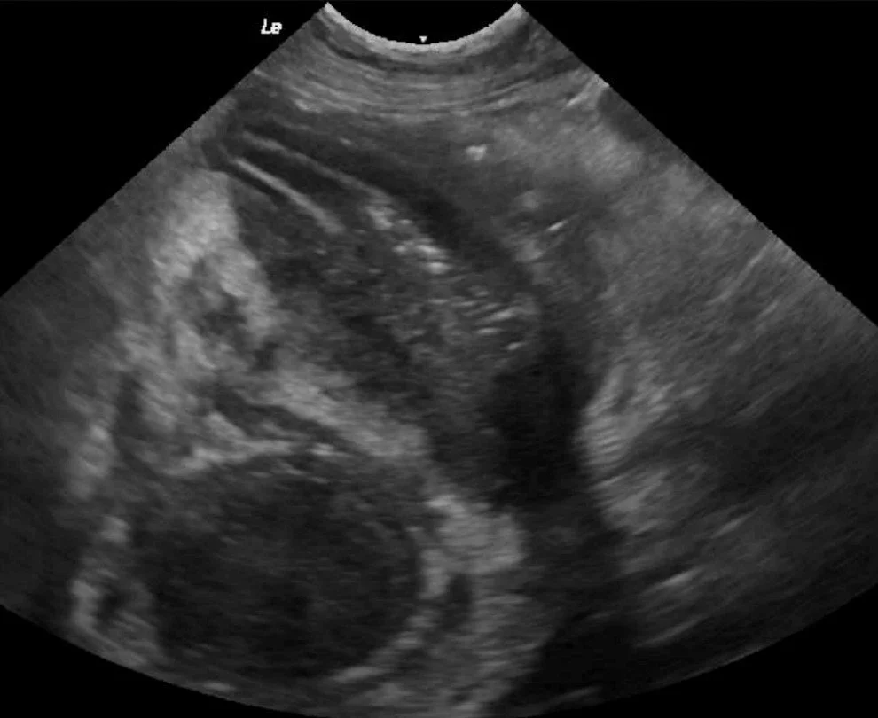 Abdominal Ultrasound