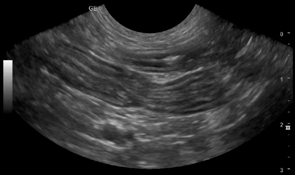 Abdominal Ultrasound