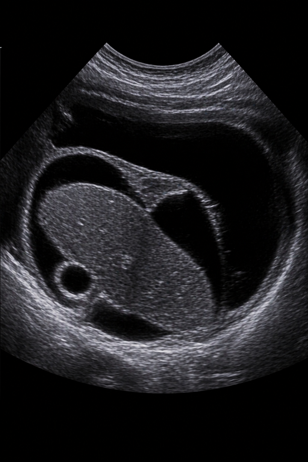 Ultrasound image of a developing fetus inside the womb.