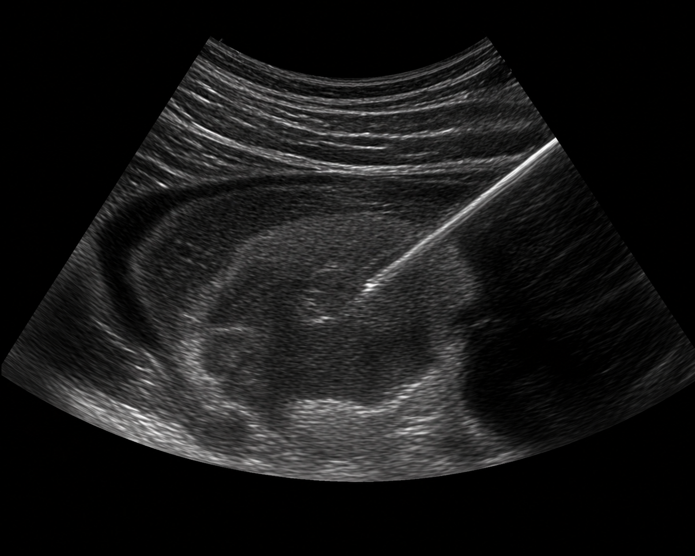 Ultrasound Guided Tissue Sampling