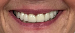Linda after treatment