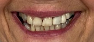 Linda before treatment