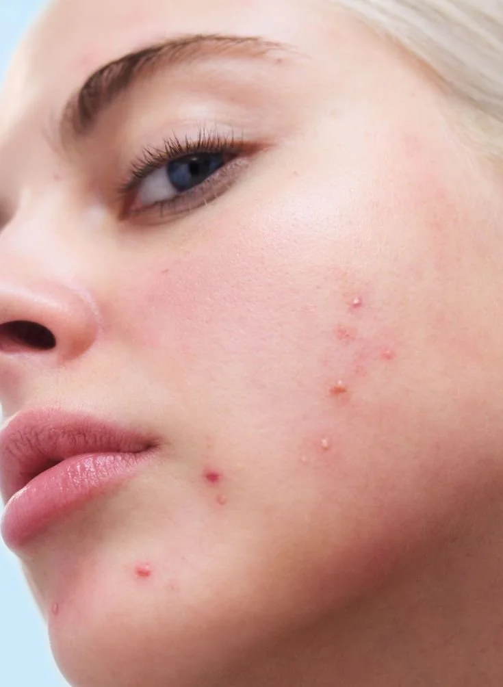 Acne Clarifying Cleanser - 120ML.jpg