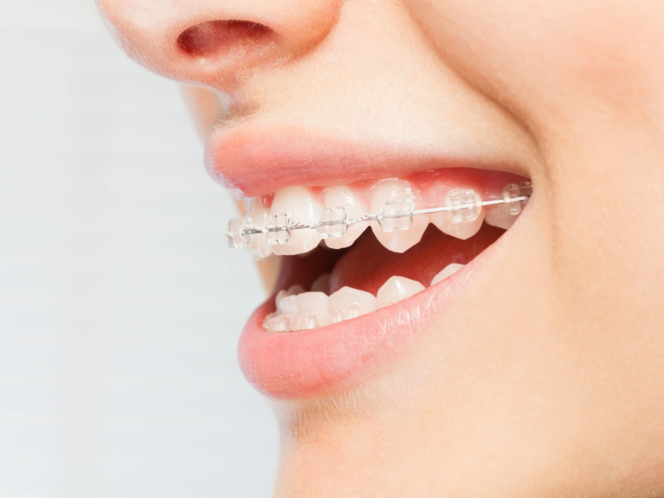 Clear Ceramic Braces with a Smile